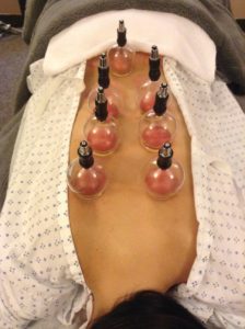 Cupping Back Treatment